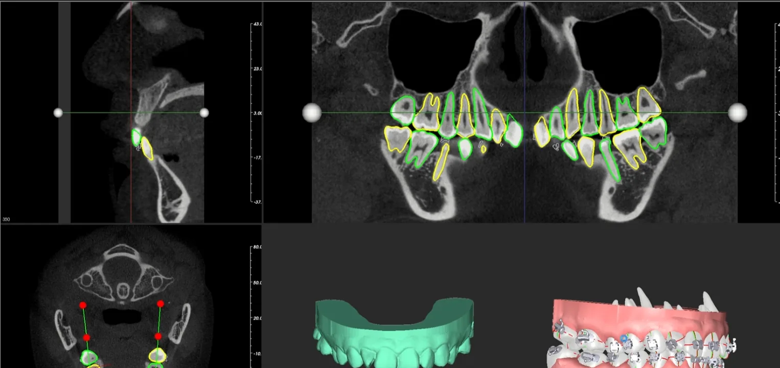 Anchorage implants planned on CBCT slices with segmented teeth in GuideMia OrthoPlus