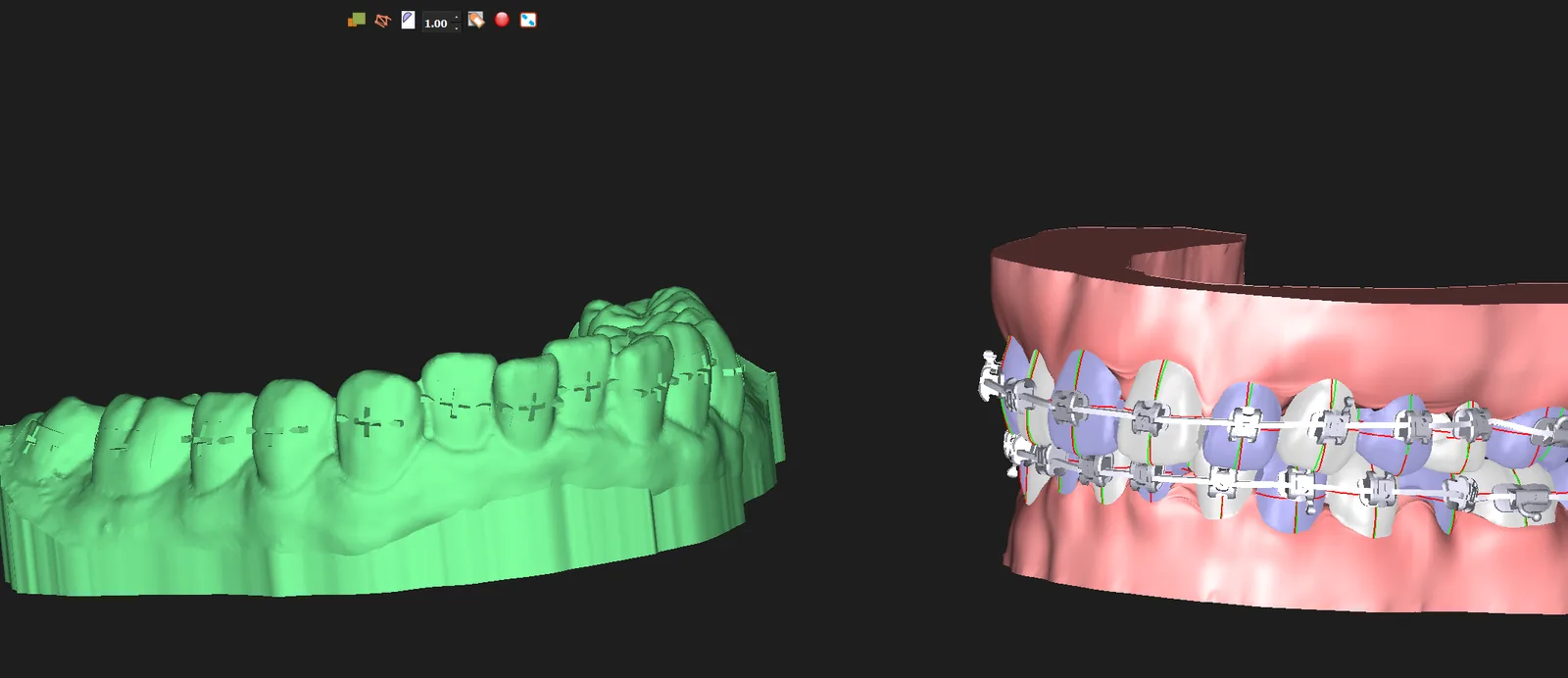 An indirect bonding base model with bracket position markers next to the bracketed arch