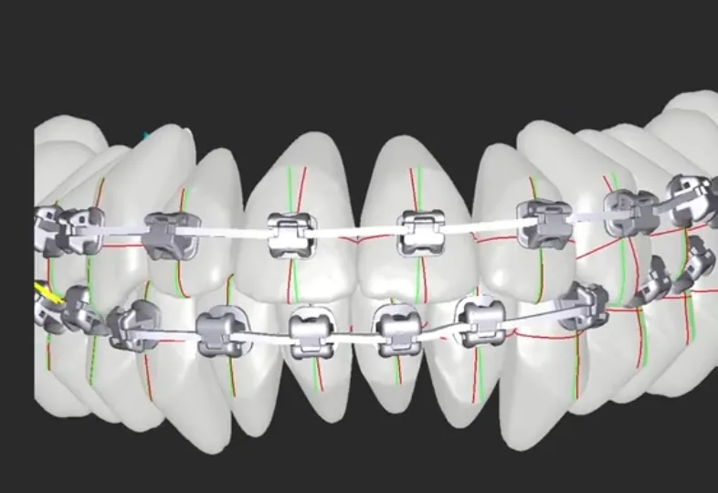 Brackets with ADB jigs placed on a digital arch setup in GuideMia OrthoPlus
