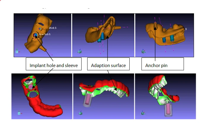 The form features of a surgical guide