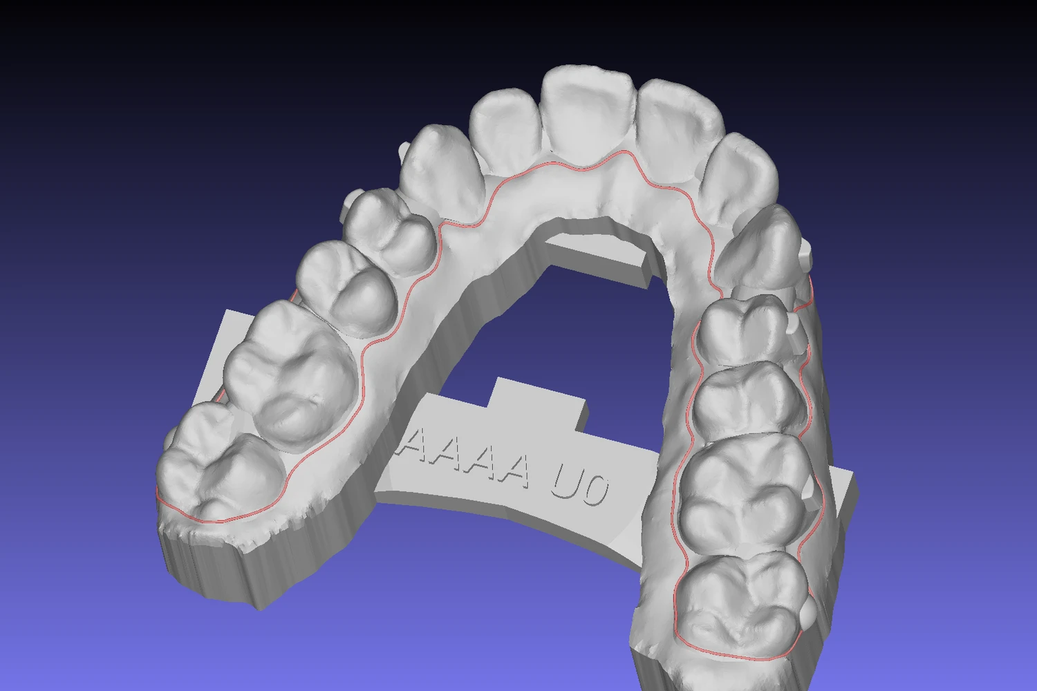 A clear aligner model with the trimming path traced in red along the gingival margin