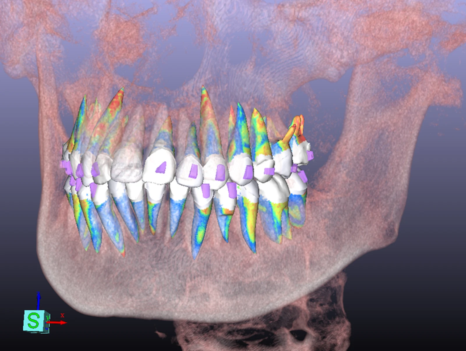 CBCT volume render with individually coloured tooth roots visible inside the translucent jaw