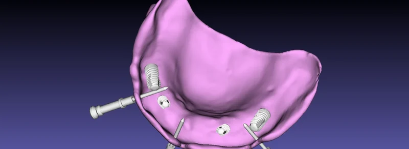 A generated full-arch surgical guide with four fixtures and three anchor pins