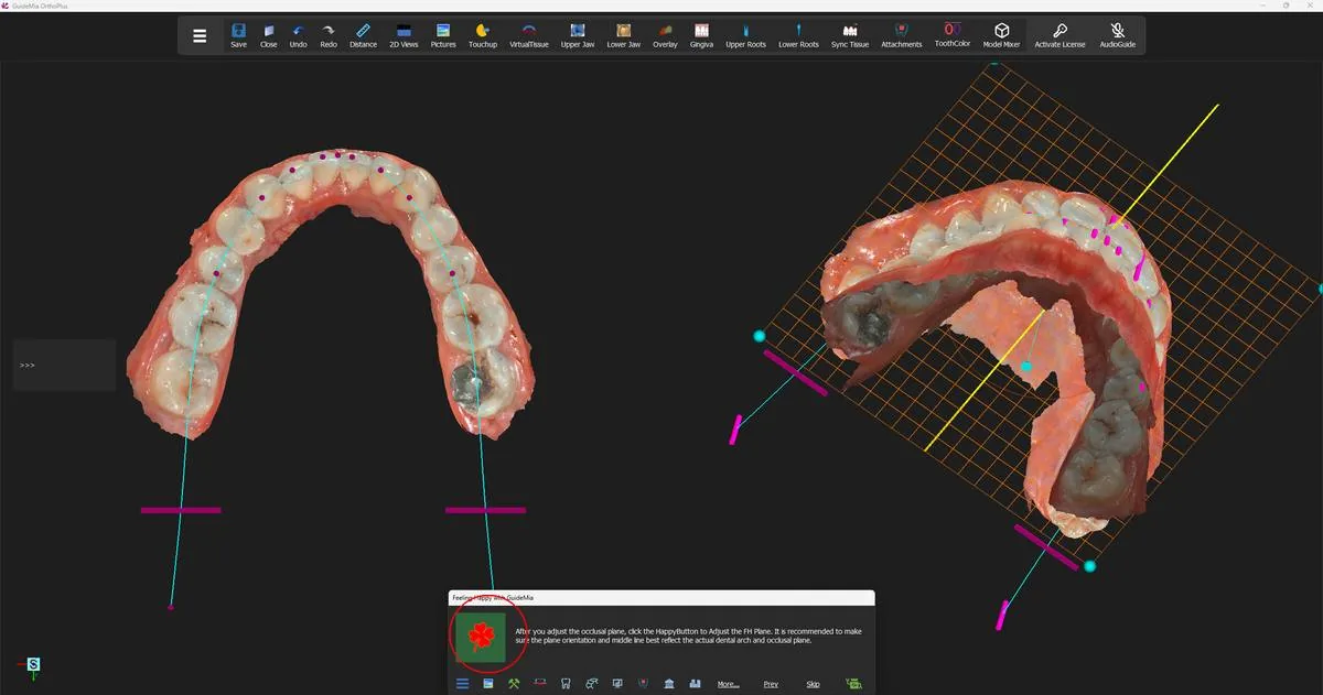 The same plane seen obliquely, where a cant that the occlusal view hides becomes visible.