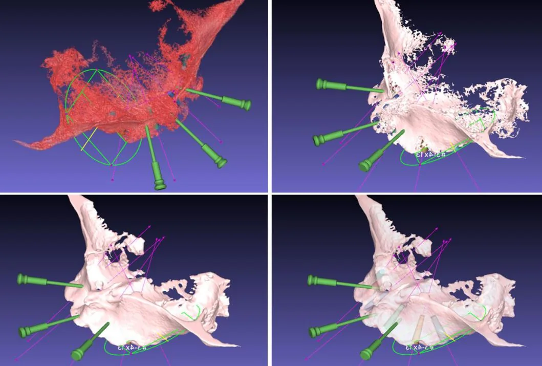 The image processing of a maxillary case: filling and smoothing the bone model