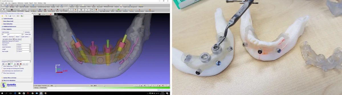 A bone-reduction guide designed in GuideMia Implant Master