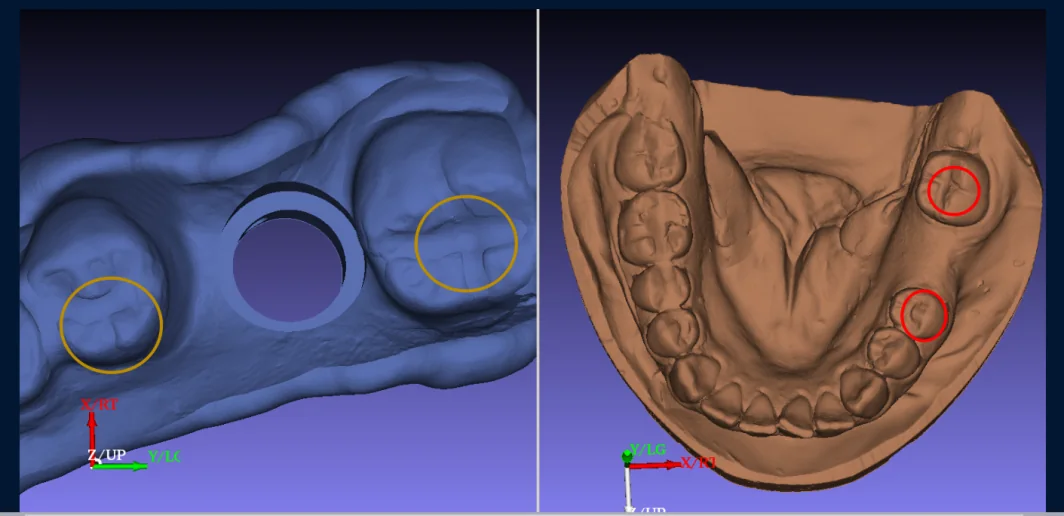 Geometric details in surgical guide design