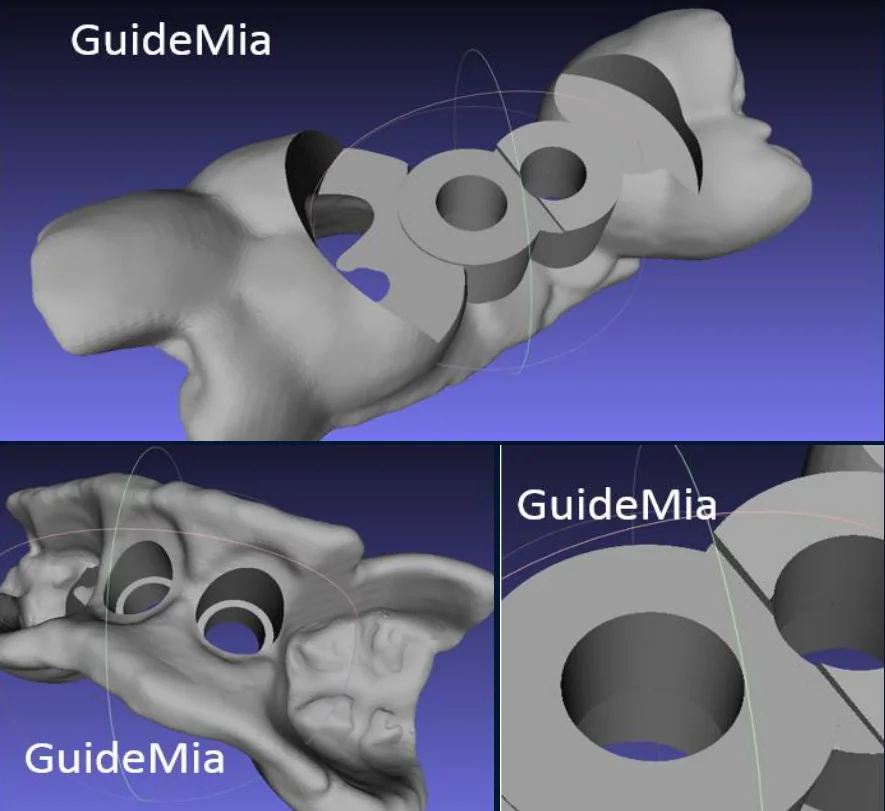 Undercut removal and the resulting surgical guide in GuideMia Implant Master