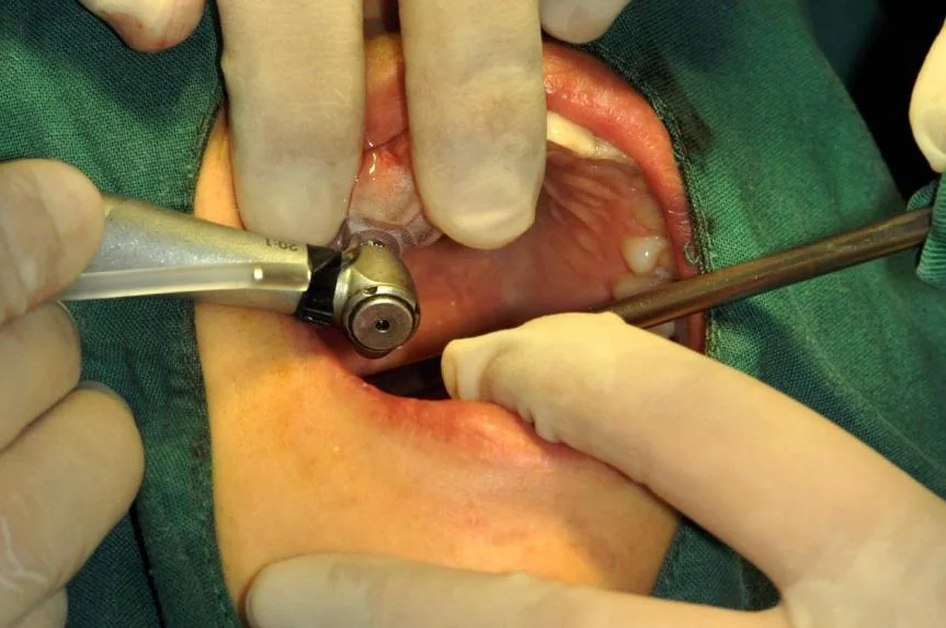 Handling a surgical guide during surgery
