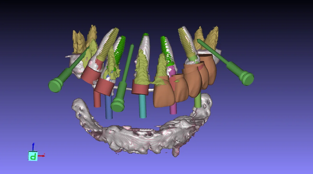 Pre-operative plan and post-operative result compared in GuideMia Implant Master