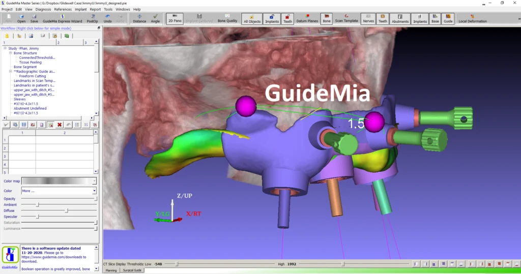 Bone-reduction guide with combined tissue support