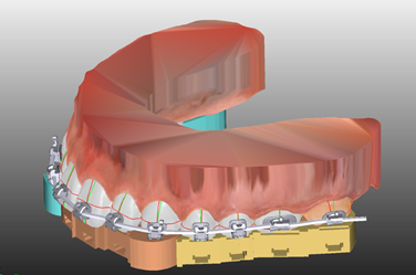 Bracket bonding guide design