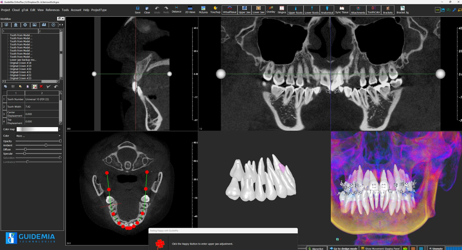 GuideMia OrthoPlus orthodontic software showing a staged aligner setup with roots and bone from CBCT
